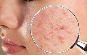راهکارهای خانگی برای رفع آکنه در کمترین زمان
